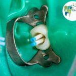 Apexification | Gutta-percha in milk teeth undergoing apexification at Dental Park, Ghaziabad