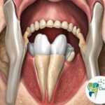 Failed root canal treatment saved by Apicoectomy performed by Dr. Aakash Arora at Dental Park Ghaziabad