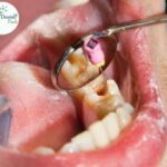 Carious tooth showing decay that can be treated by the best dentists at Dental Park with a tooth filling