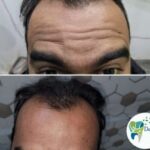 Botox injection in Ghaziabad