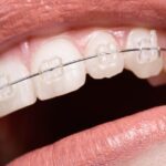 Ceramic braces
