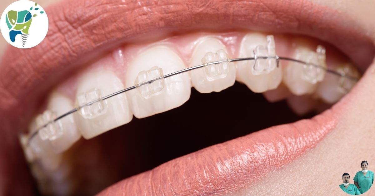 Ceramic braces