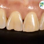 Close-up image of cracked teeth, showcasing various types of cracks including hairline cracks and vertical root fractures, illustrating the need for expert treatment from Dental Park.