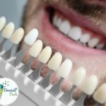 Dental veneer in ghaziabad