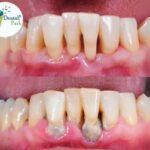 Gum grafting in Ghaziabad