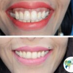 Gum Plastic Surgery