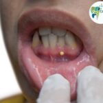 Gum Pocket Reduction Surgery