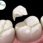 Best restorative dentists at Dental Park offering high-quality dental crowns, inlays, and onlays at economical rates in Delhi NCR