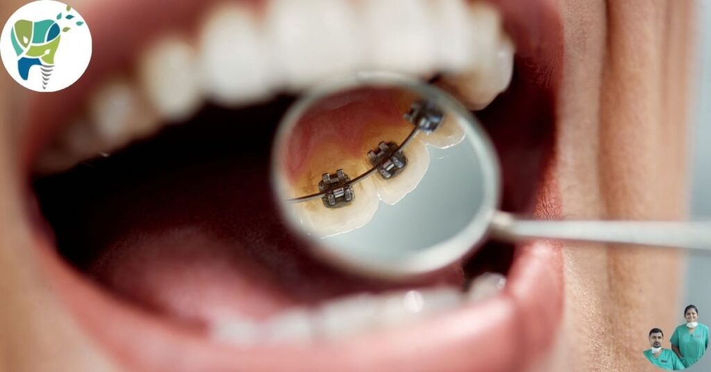 Lingual braces
