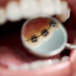 Lingual braces