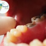 Grossly carious molar tooth treated expertly at Dental Park Ghaziabad