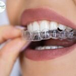 Best Mouth Guard at Affordable Price by Top Dentists at Dental Park