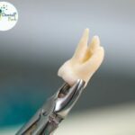 Painless Affordable Tooth Extraction Price in Ghaziabad by Dr. Aakash Arora at Dental Park