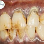 Periodontal Flap Surgery