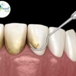 Teeth Scaling and Root Planing in Ghaziabad