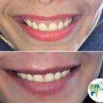 Smile design before and after effect by Dr. Aakash Arora and Dr. Jaisika Rajpal Arora at Dental Park Ghaziabad