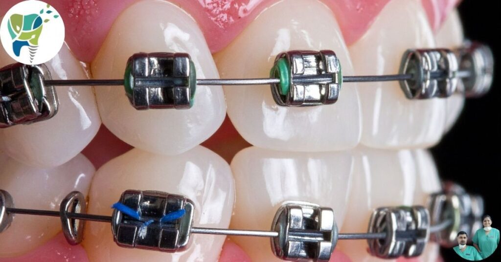 Traditional Metal Braces treatment near ghaziabad