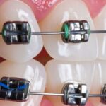 Traditional Metal Braces treatment near ghaziabad