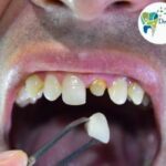 Dental Crown in Ghaziabad