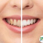 Teeth whitening procedure at Dental Park Ghaziabad available at affordable prices