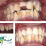 Best dentists for chipped tooth bonding at Dental Park, offering economical rates in Delhi NCR