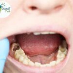 Decayed tooth in a child treated at Dental Park Ghaziabad