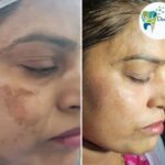 Before and after results of scar revision surgery performed by Dr. Aakash Arora at Dental Park Ghaziabad.