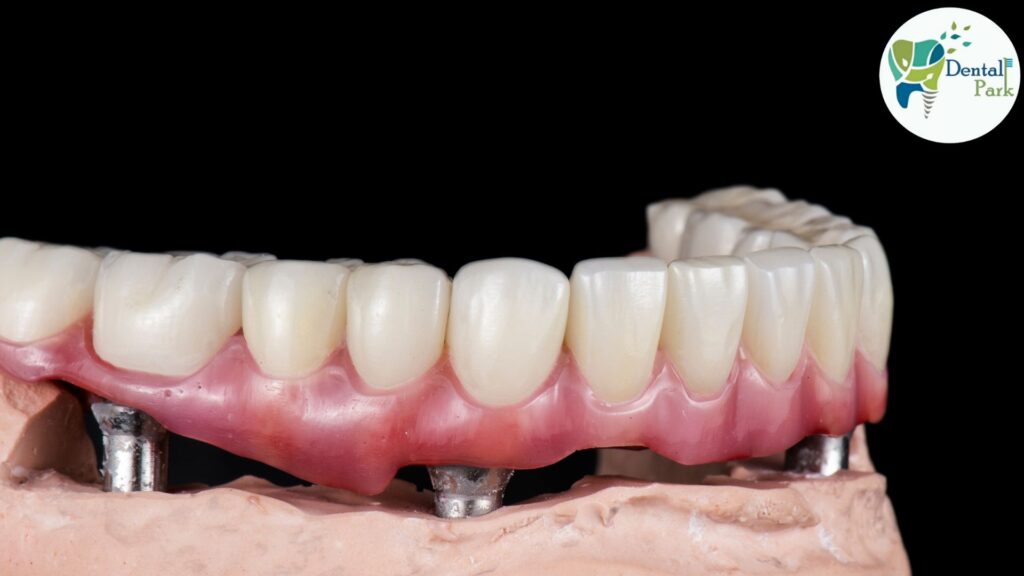 Best Dental Clinic in Ghaziabad | Dental Park Dental Implant near me | All-on-4 Dental Implants | Best Dental Implant in Ghaziabad | Dental Implant in Ghaziabad | implant overdenture