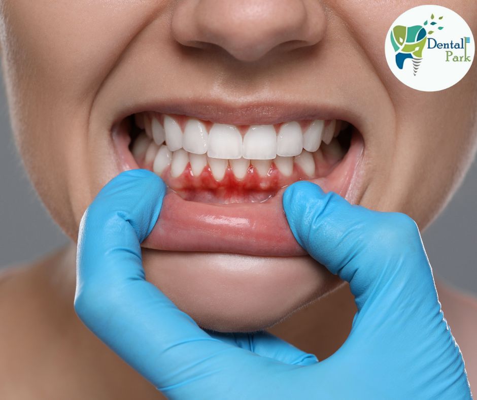 Best Dental Clinic in Ghaziabad | Dental Park Gum hyperplasia treatment | dentist near me | best dentist near me | gum disease expert | swollen gums in pregnancy | pregnancy