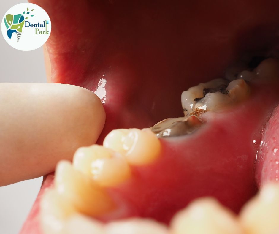 Best Dental Clinic in Ghaziabad | Dental Park दांत की नस का इलाज। रुट कैनाल ट्रीटमेंट। दांत दर्द का इलाज। मेरे पास दांतो का डॉक्टर। दांतो का डॉक्टर। दन्त विशेषज्ञ। दांतो का इलाज। दांत में कीड़े का इलाज। दांत भरने के लिए डॉक्टर। डेंटिस्ट