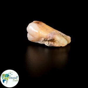 Best Dental Clinic in Ghaziabad | Dental Park rotten tooth extraction cost | rotten tooth extraction | dental costs Ghaziabad | affordable dentistry | tooth pain relief | dental procedures | oral health | emergency dental care | dental savings | tooth decay | dental insurance | painless extraction | dental clinic Ghaziabad | tooth removal | dental hygiene | oral surgery