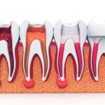 root canal | dental pain | tooth treatment | endodontics | dental health | root canal procedure | oral care | tooth preservation | dental myths | dentist tips | dental anxiety | tooth extraction alternatives