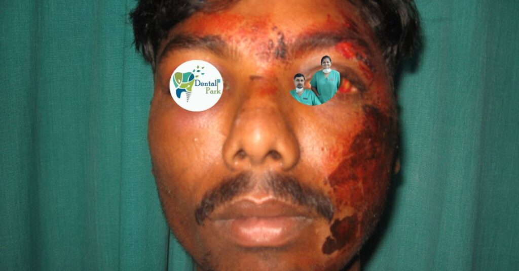 Best Dental Clinic in Ghaziabad | Dental Park fractured jaw | fractured jaw treatment | jaw fracture surgery | jaw bone fracture | fractured jaw pain | fractured jaw recovery | upper jaw fracture after tooth fracture | fractured jaw diet | fractured jaw symptoms | fractured jaw x ray | how to know if jaw is fractured | jaw fracture surgery cost | jaw fracture surgery cost in india | upper jaw fracture | Facial Trauma Treatment