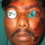 fractured jaw | fractured jaw treatment | jaw fracture surgery | jaw bone fracture | fractured jaw pain | fractured jaw recovery | upper jaw fracture after tooth fracture | fractured jaw diet | fractured jaw symptoms | fractured jaw x ray | how to know if jaw is fractured | jaw fracture surgery cost | jaw fracture surgery cost in india | upper jaw fracture | Facial Trauma Treatment