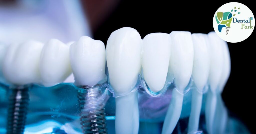 Best Dental Clinic in Ghaziabad | Dental Park Multiple Teeth Implants