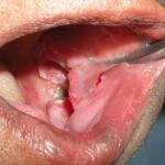 Oral cancer | Mouth cancer | Head and neck cancer | Tumor resection | Partial glossectomy | Mandibulectomy | Maxillectomy | Neck dissection | Reconstructive surgery | Surgical oral cancer surgery | Chemotherapy | Radiotherapy | Early detection | Oral cancer screening