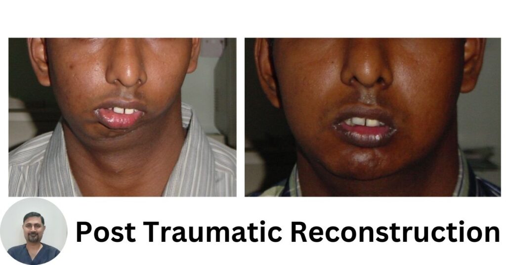 Best Dental Clinic in Ghaziabad | Dental Park Post Traumatic Reconstruction