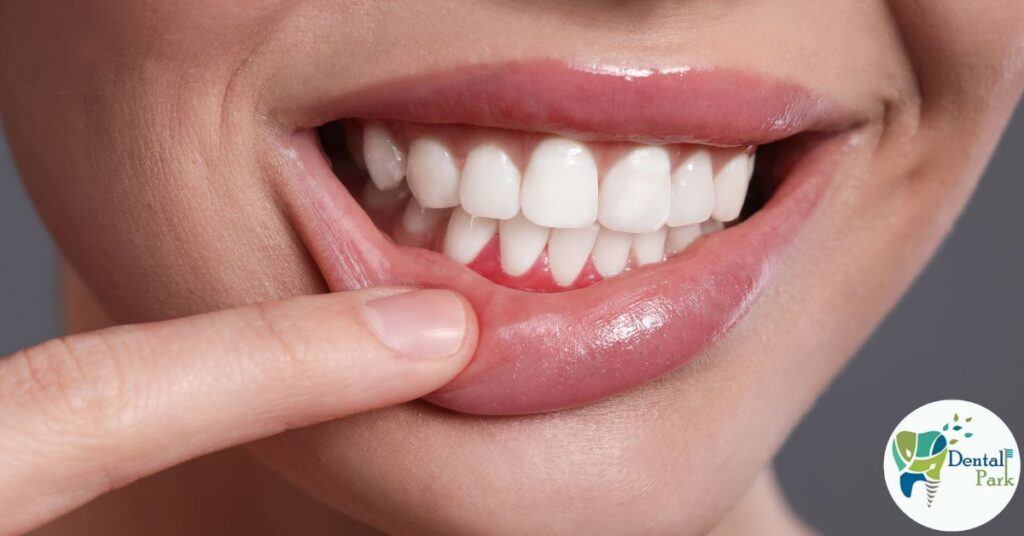 Best Dental Clinic in Ghaziabad | Dental Park Coronally Advanced Flap