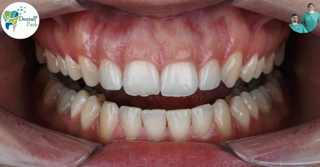 Best Dental Clinic in Ghaziabad | Dental Park Free Gingival Graft