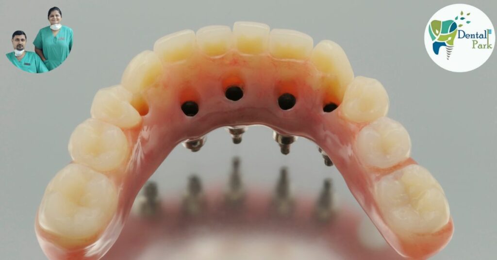 Best Dental Clinic in Ghaziabad | Dental Park Implant-Supported Bridges