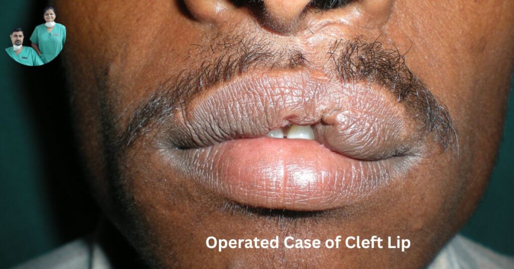Best Dental Clinic in Ghaziabad | Dental Park cleft lip | cleft palate | cleft treatment