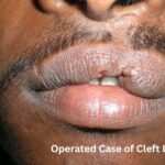 cleft lip | cleft palate | cleft treatment