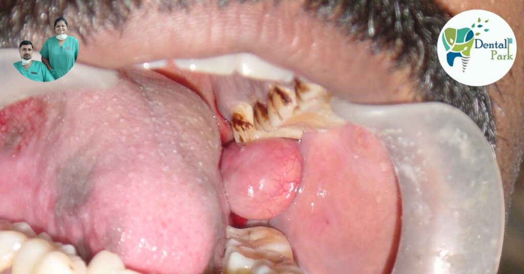 Best Dental Clinic in Ghaziabad | Dental Park Pathology | Growth | Growth in mouth | intraoral swelling | face swelling