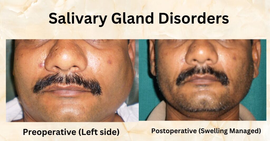 Best Dental Clinic in Ghaziabad | Dental Park Salivary Gland Disorders