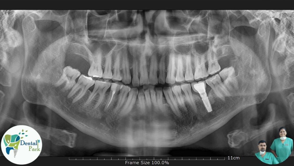 Best Dental Clinic in Ghaziabad | Dental Park Same-Day Dental Implant