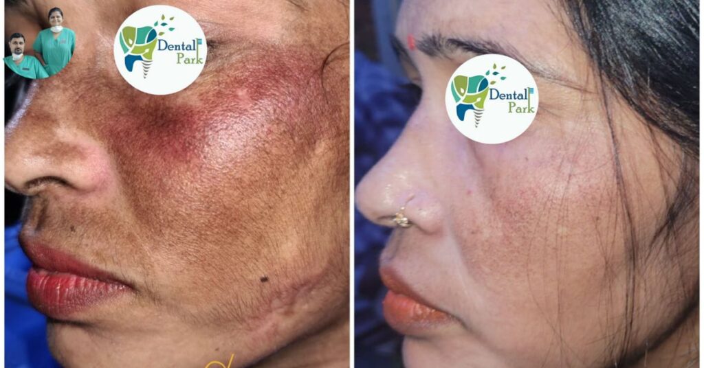 Best Dental Clinic in Ghaziabad | Dental Park Topical Scar Treatments