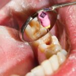 Endodontic Retreatment