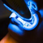Laser Teeth Whitening