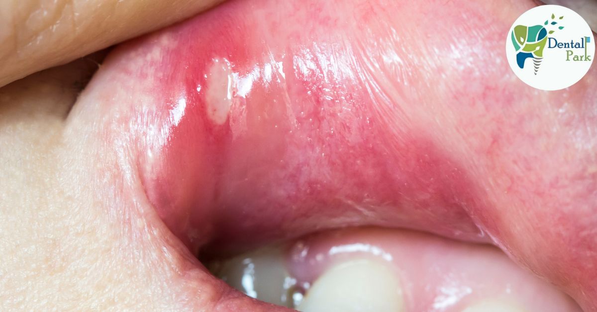 Best Dental Clinic in Ghaziabad | Dental Park mouth ulcer on lip