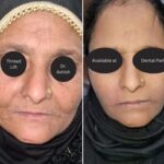 Thread Lift Surgery